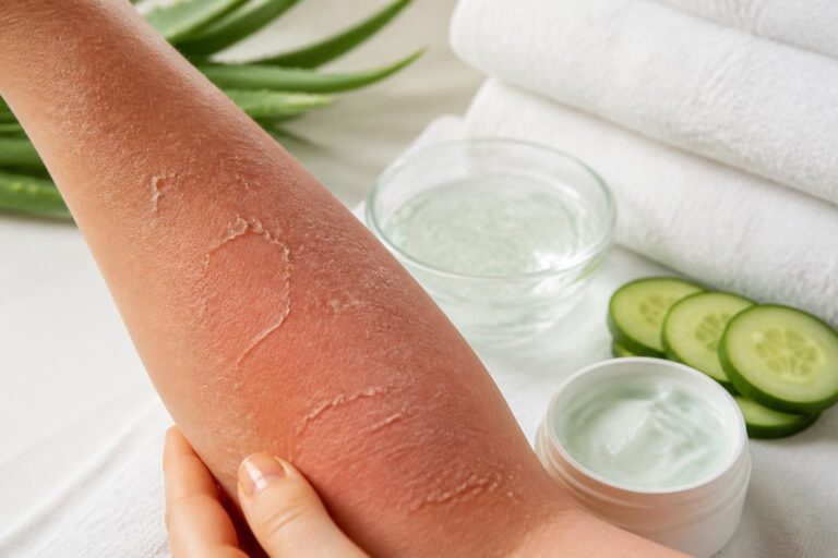 découvrez des solutions efficaces pour apaiser rapidement la peau qui pèle après une exposition au soleil et retrouvez une peau douce et hydratée.