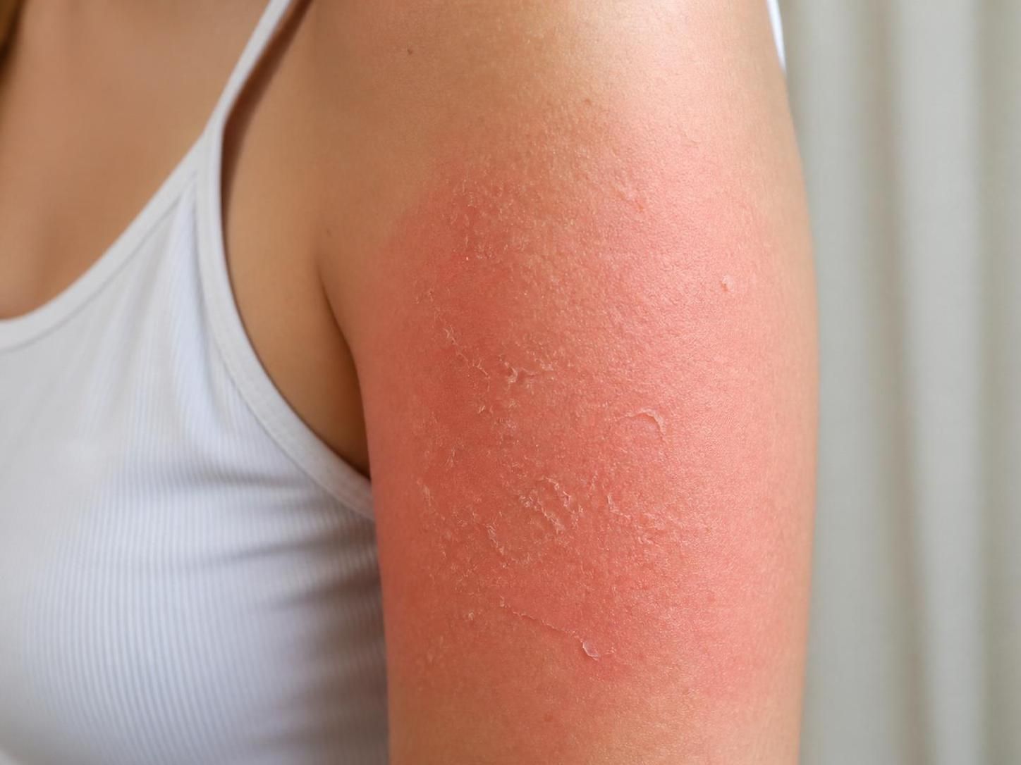 découvrez comment apaiser rapidement la peau qui pèle après une exposition au soleil grâce à nos conseils efficaces et naturels pour restaurer l'hydratation et le confort de votre peau.